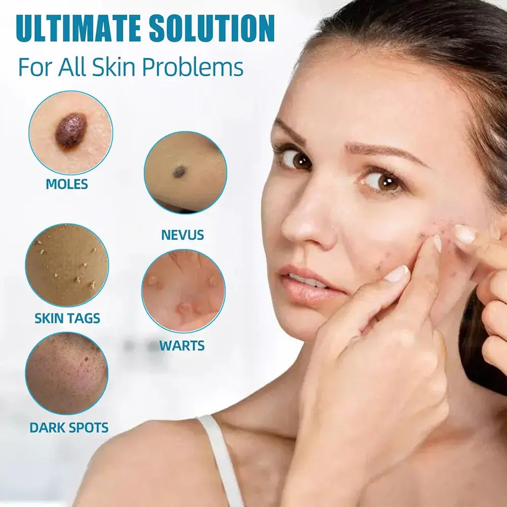 Mole And Wart Removal Pen Non Invasive Mole And Wart Removal