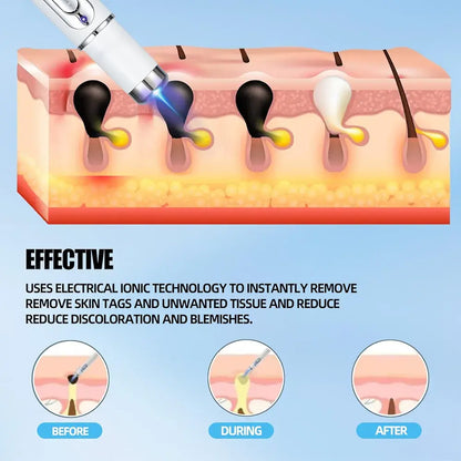 Mole And Wart Removal Pen Non Invasive Mole And Wart Removal