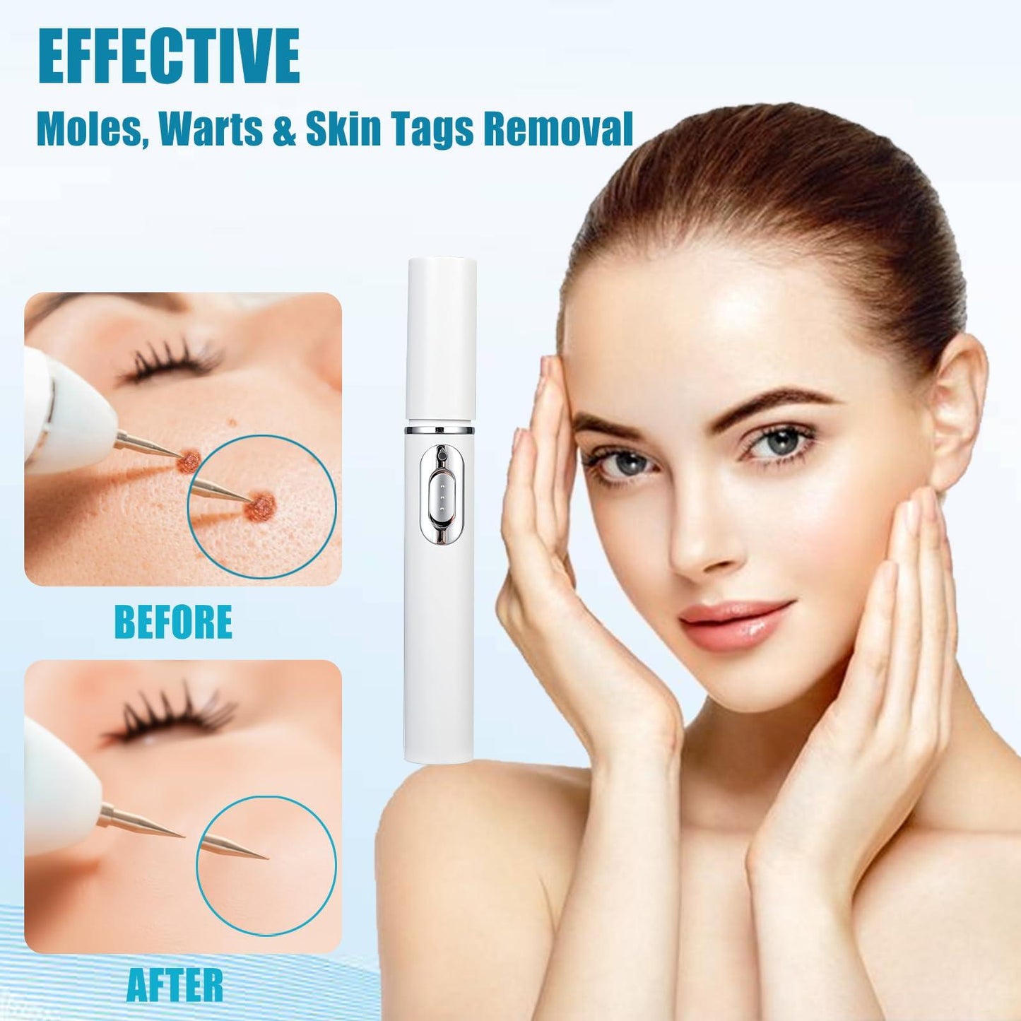 Mole And Wart Removal Pen Non Invasive Mole And Wart Removal
