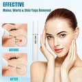 Mole And Wart Removal Pen Non Invasive Mole And Wart Removal