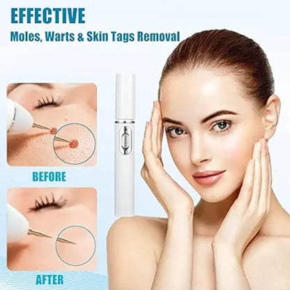 Mole And Wart Removal Pen Non Invasive Mole And Wart Removal